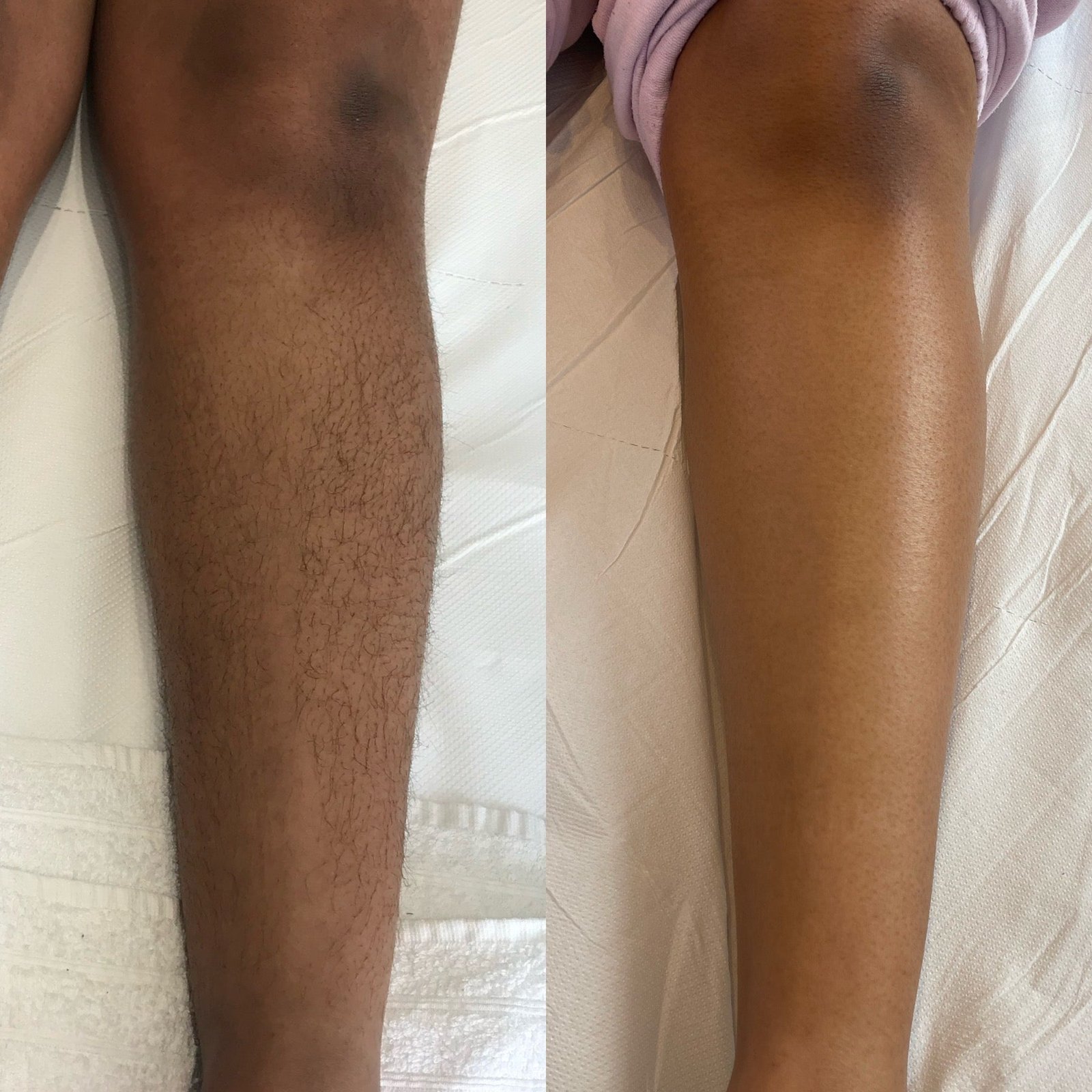 Laser hair removal before and after result