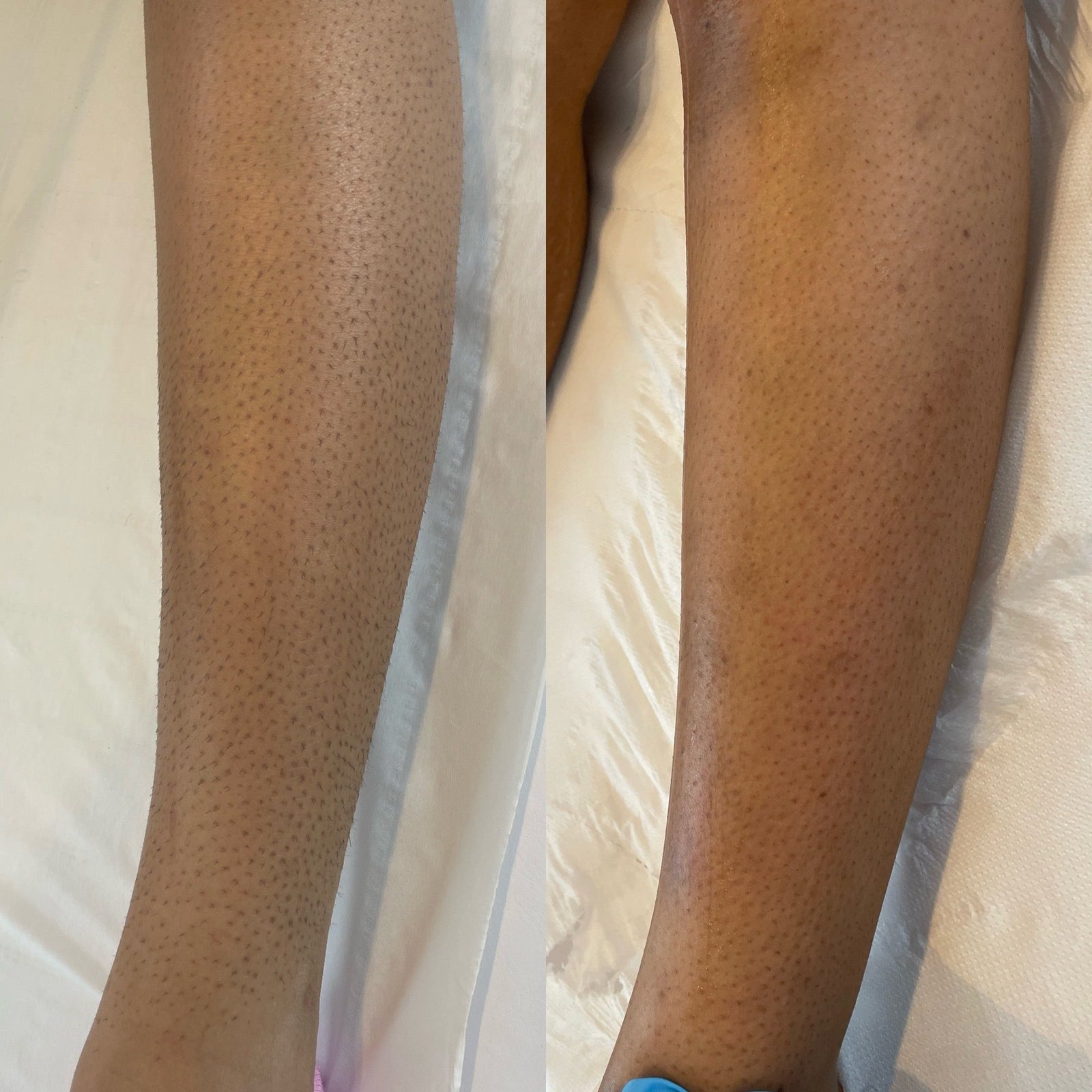 Laser hair removal before and after result